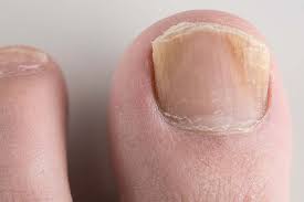 Fungal infection color changes